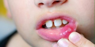 علاج هربس الفم عند الاطفال بالاعشاب