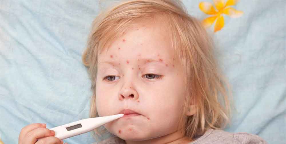 اعراض الجدري المائي عند الاطفال