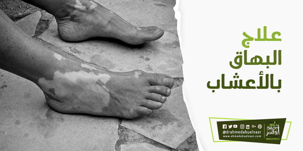 علاج البهاق بالاعشاب | د احمد ابو النصر
