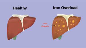 علاج زيادة الحديد في الكبد