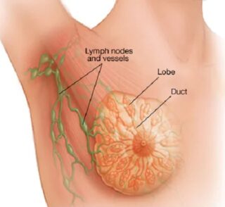 الورم الليفي في الثدي