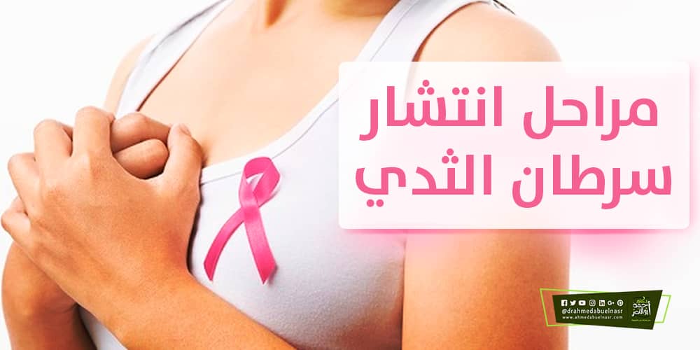 مراحل انتشار سرطان الثدي