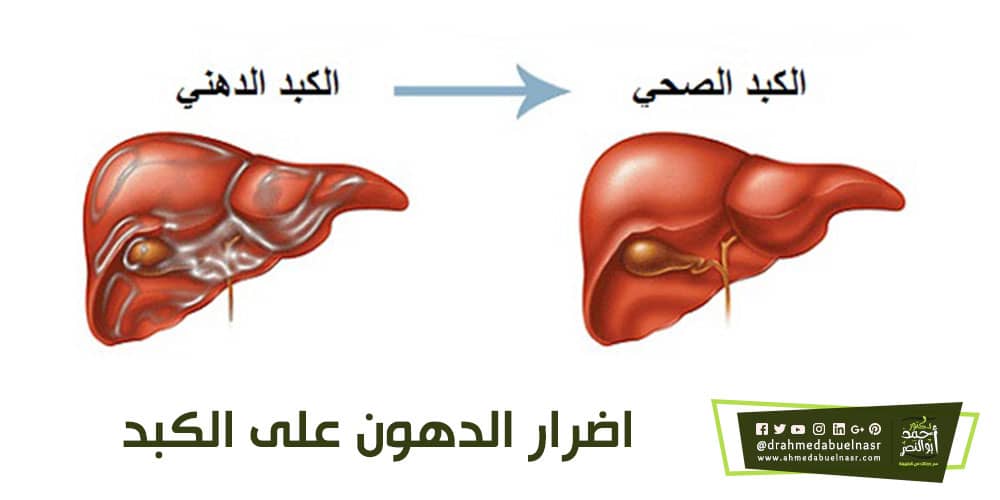 اضرار الدهون على الكبد