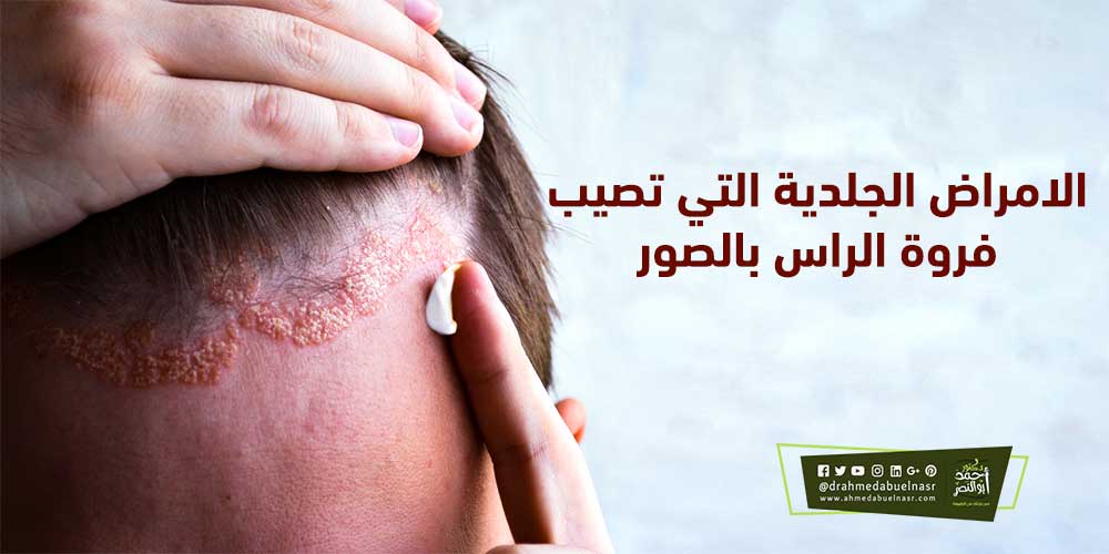 الأمراض الجلدية التي تصيب فروة الرأس بالصور