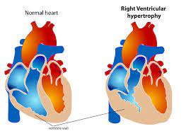 اعراض تصخم عضلة القلب