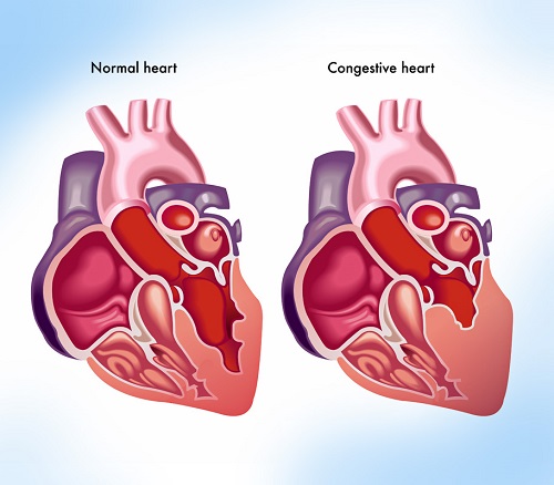 اعراض ضعف عضلة القلب