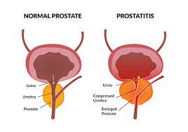 ما هى اعراض التهاب البروستاتا