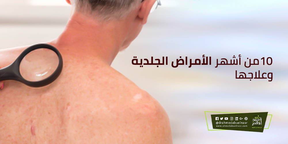 أشهر الأمراض الجلدية