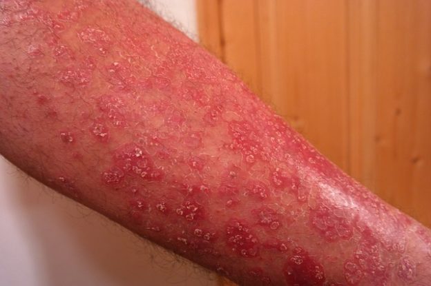  أشهر الأمراض الجلدية