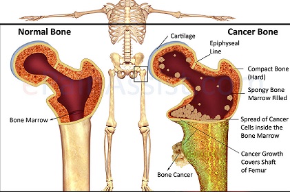 اعراض سرطان العظام والمفاصل