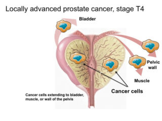 أعراض سرطان البروستاتا