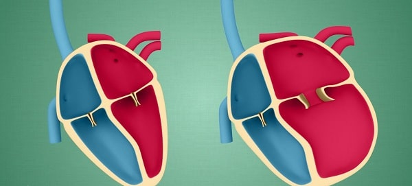 ما هو تضخم عضلة القلب